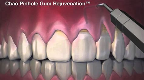 Introducing Pinhole Gum Rejuvenation Receding Gums .